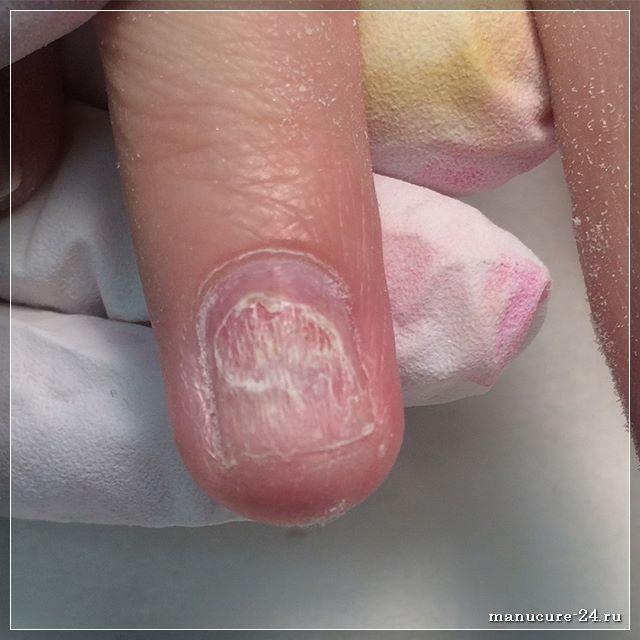 Как распознать грибок ногтей: основные симптомы