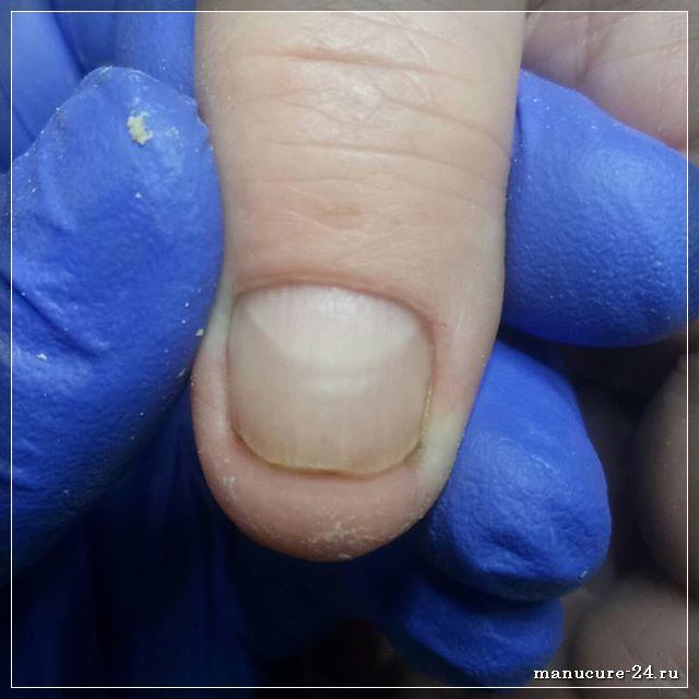 Как распознать грибок ногтей: основные симптомы