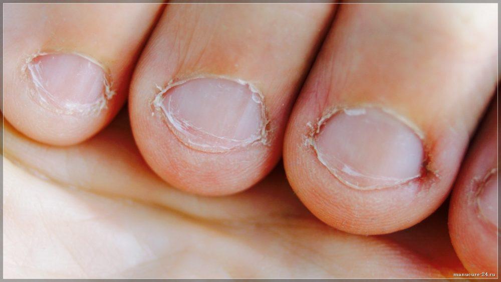 Последствия вредных привычек: перестаем грызть ногти