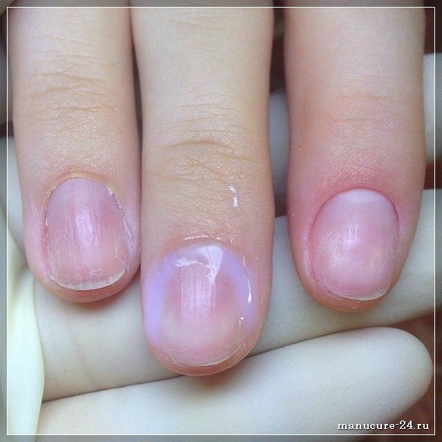 Профилактика болезней ногтей на руках